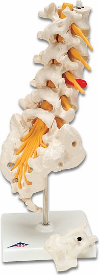 Columnavertebral lumbar con hernia discal dorsolateral  A76/5